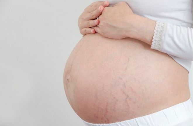 phòng và trị rạn da cho bà bầu phòng và trị rạn da cho bà bầu